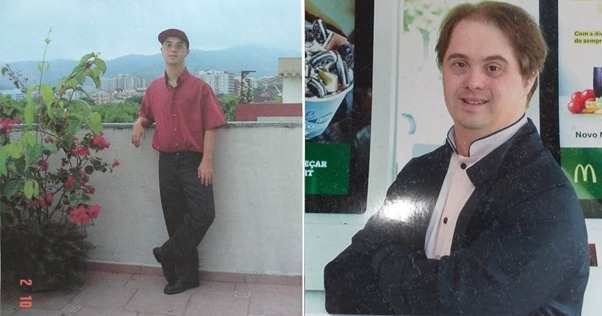 síndrome de down